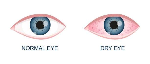  Difference between the Normal eye and dry Eyes