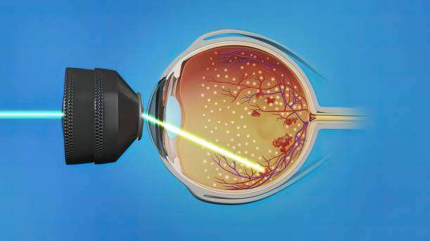 Retinal detachments laser treatments
