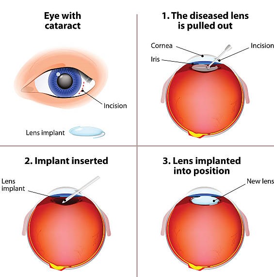 Cataract Surgery process