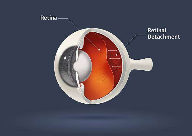 Retinal detachment of the eye
