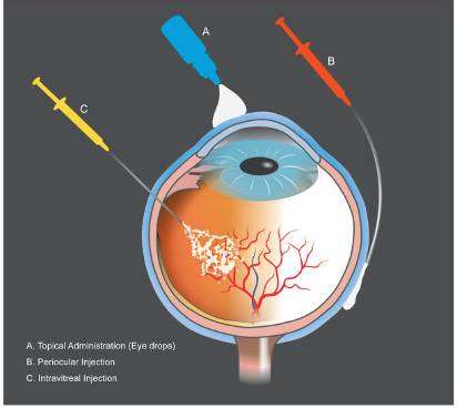 Intravitreal Injections for retinal detachment treatment