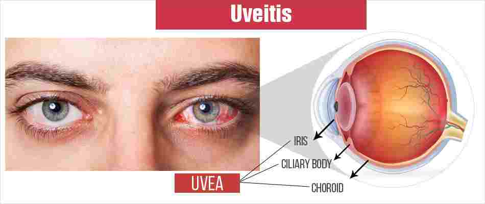 There are 3 types of uvea: iritis, cyclitis, and Choroiditis