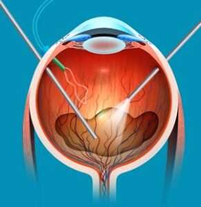 Vitreoretinal-surgery for Retina 