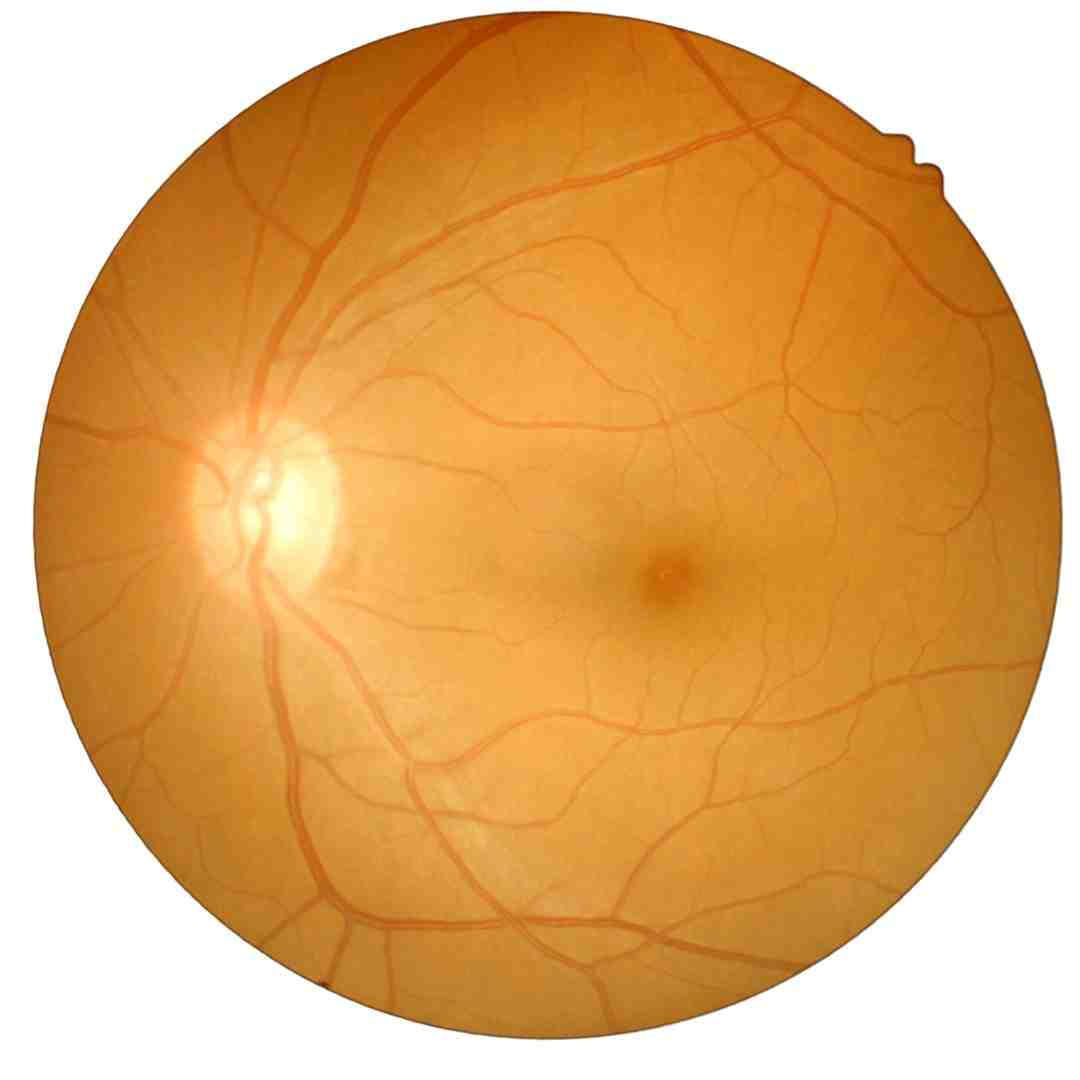 Retinal Detachment