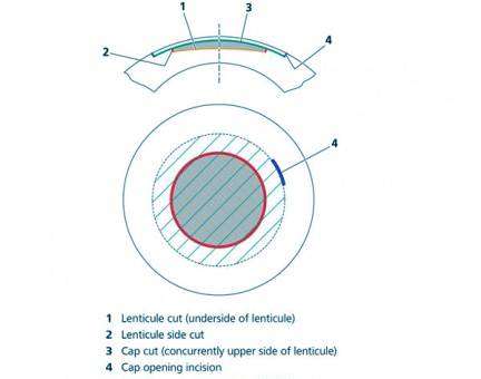 This image shows the surgery process step by step