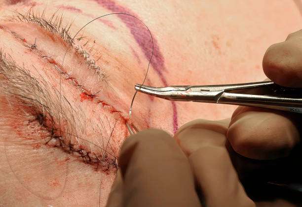 A plastic surgeon puts in the final sutures as he completes an upper eyelid blepharoplasty.
