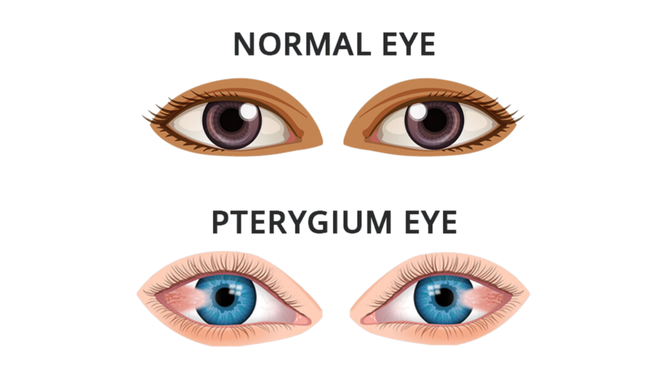 pterygium eyes and normal eyes