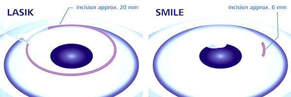 This image shows how smile is most popular then lasik