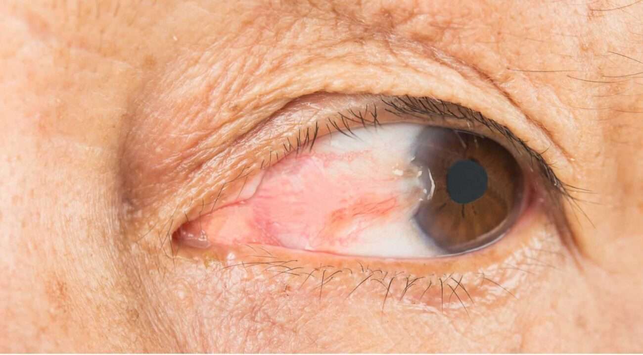 this image is shows that pterygium of the eye