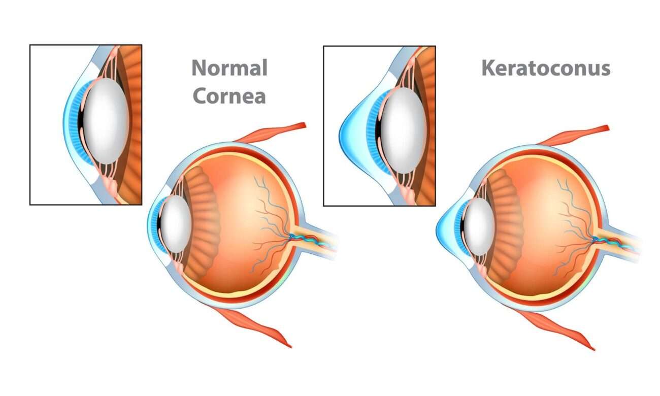 Normal Cornea and Keratoconus