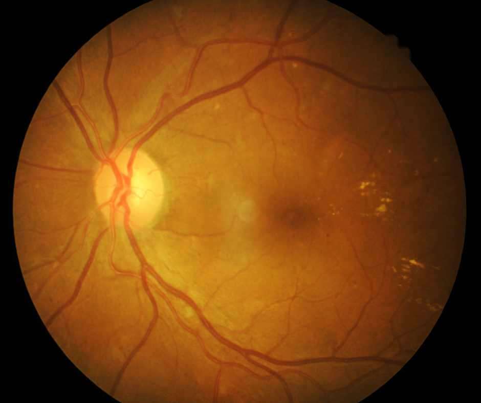 This is the simple Image of retina  And retinal detachment surgery