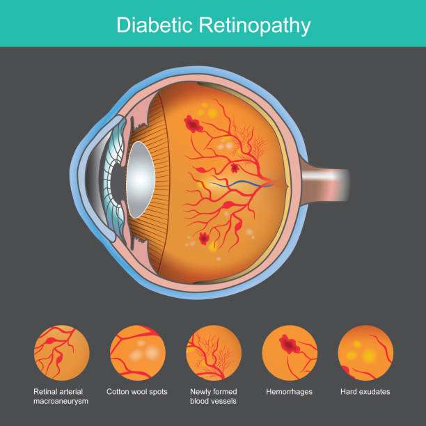 Diabetic Retinopathy. Illustration abnormality the retina from symptoms the diabetic retinopathy.