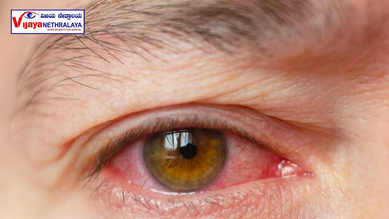a close-up of an eye with visible redness in the sclera (white part of the eye) caused by blood vessels that are dilated or swollen."