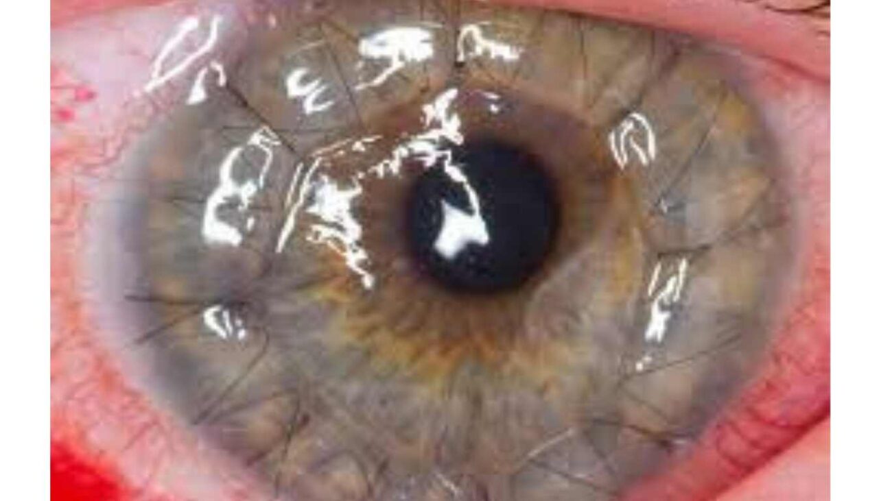 cornea button one day after surgery