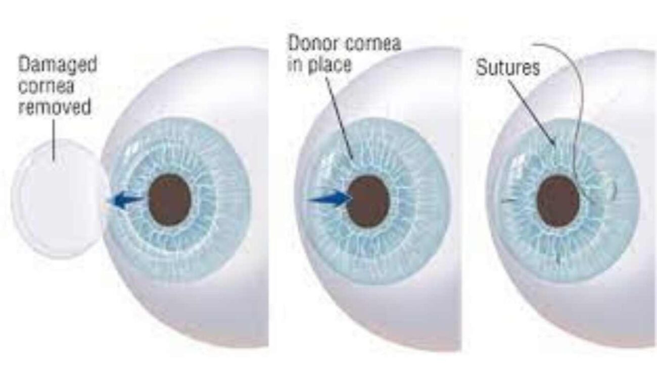 damaged cornea removed, and donor cornea in place, sutures 