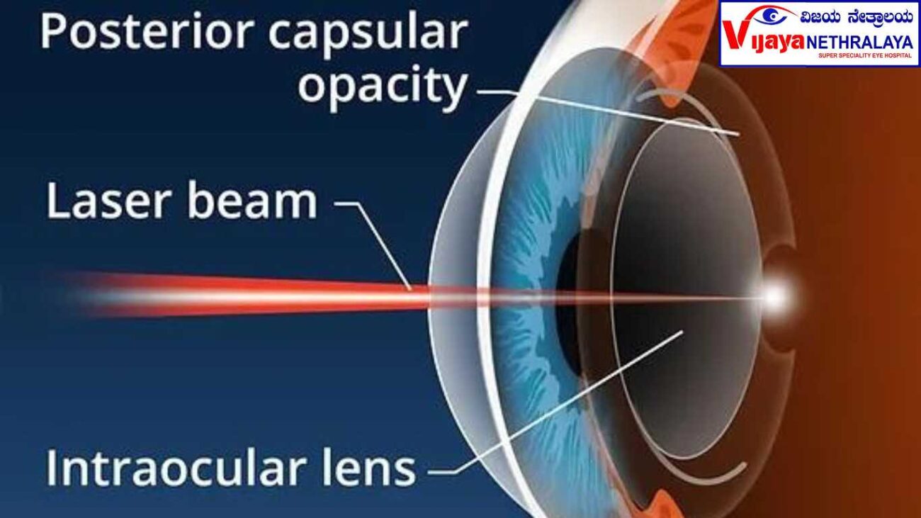 this image shows Posterior Capsule Opacification  procedure 