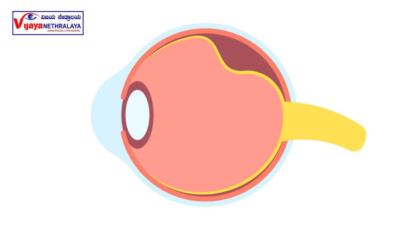 keratoconus eye image 