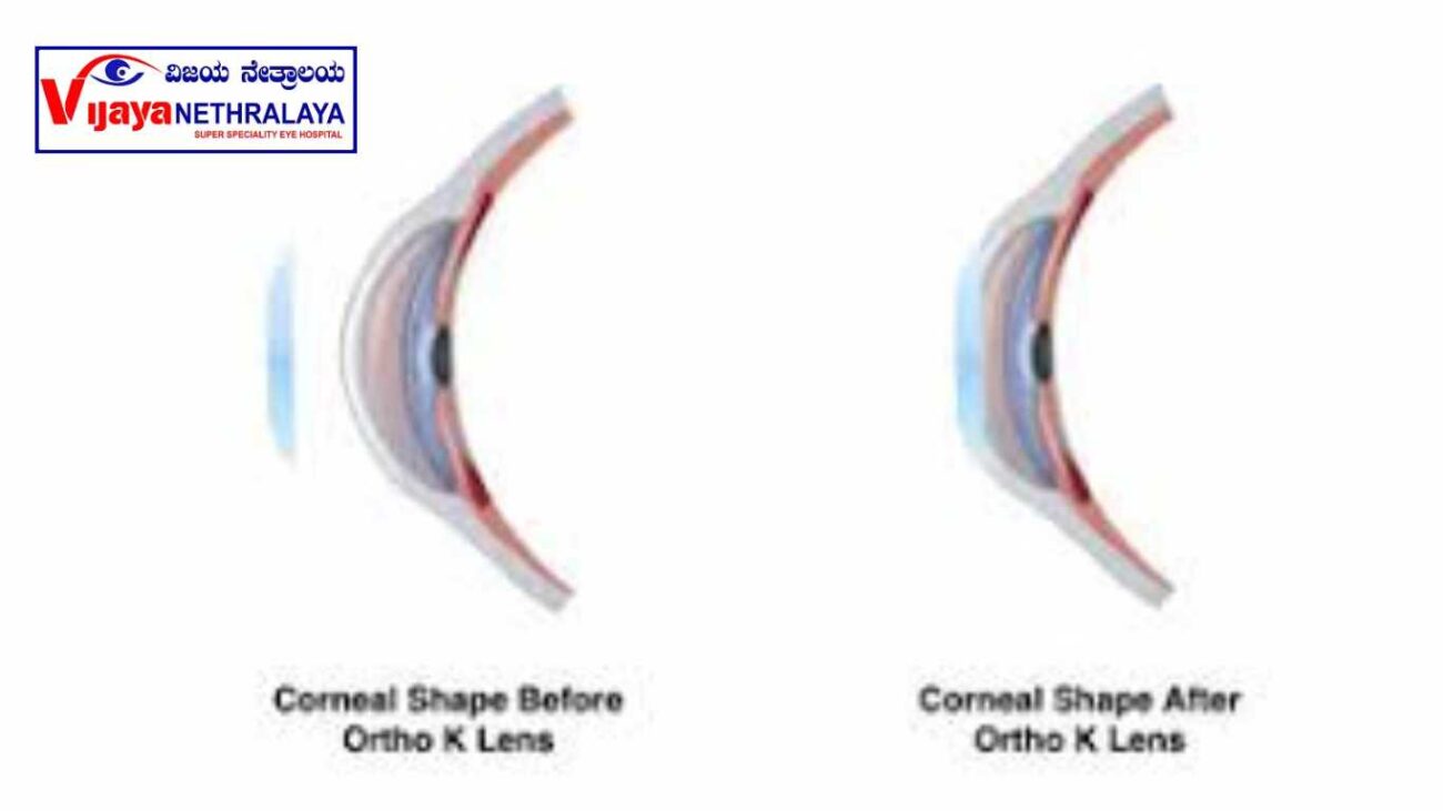 Corneal Reshaping 