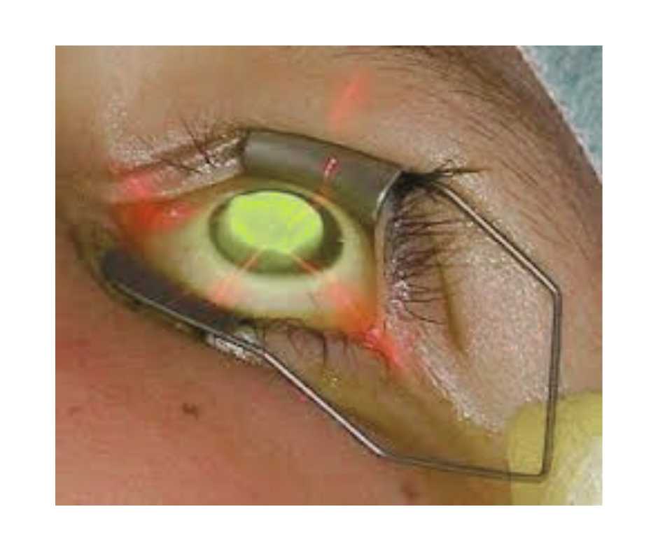 Cross-Linking Eye Surgery