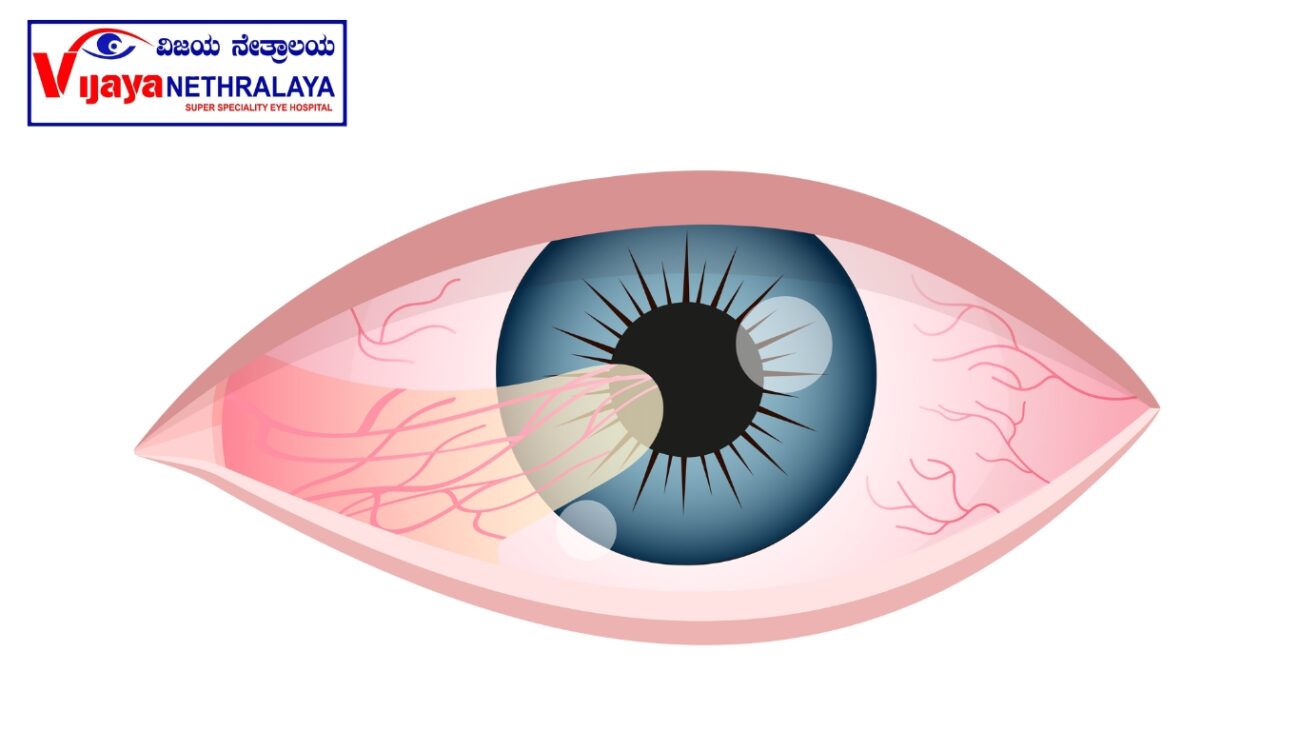 pterygium eye 