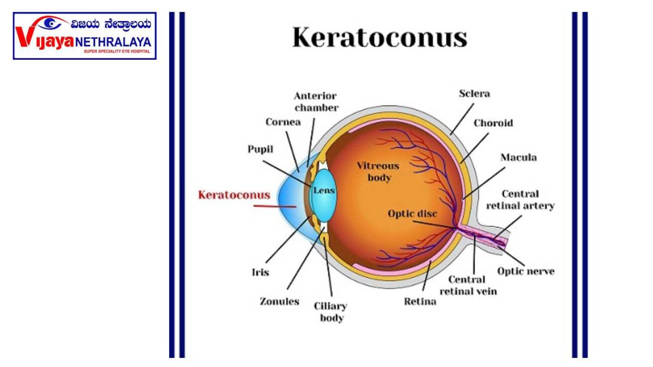 signs of keratoconus. 