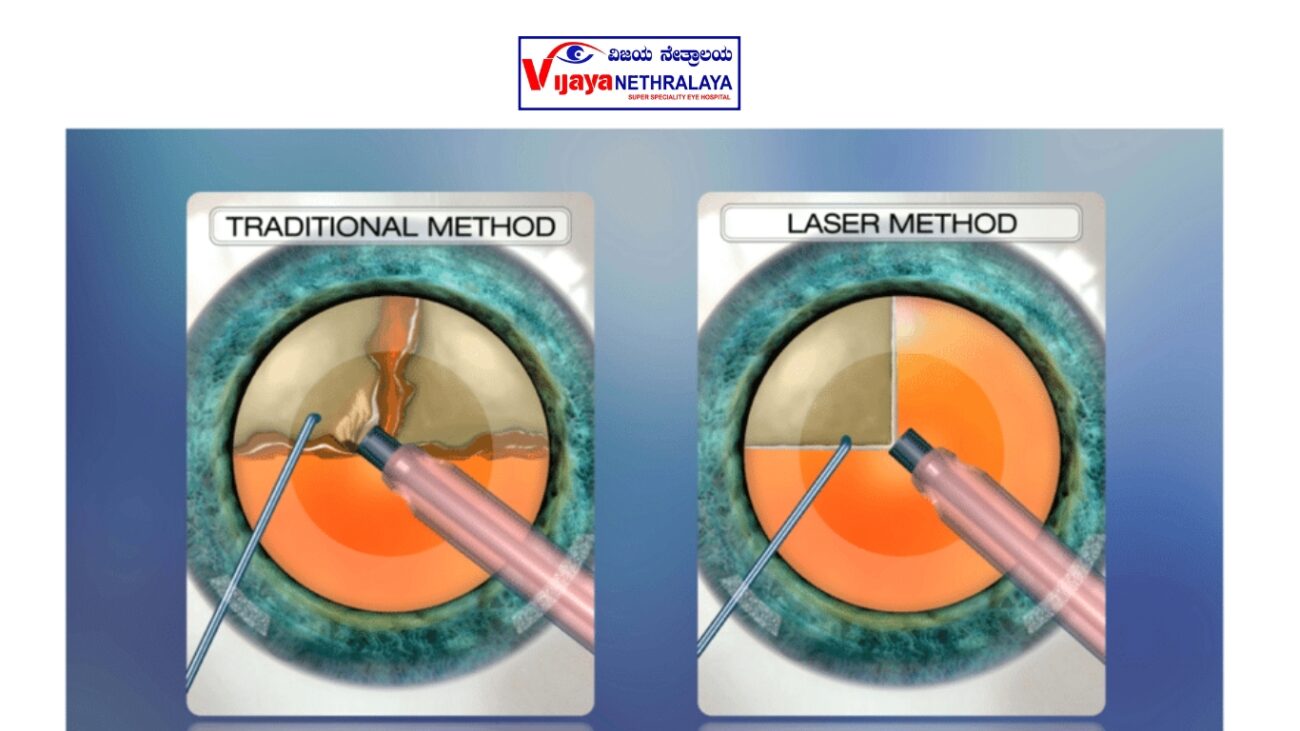 Traditional Cataract Surgery