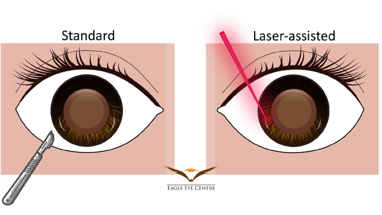 Standard Cataract Surgery eye image for Cost of Cataract Operation