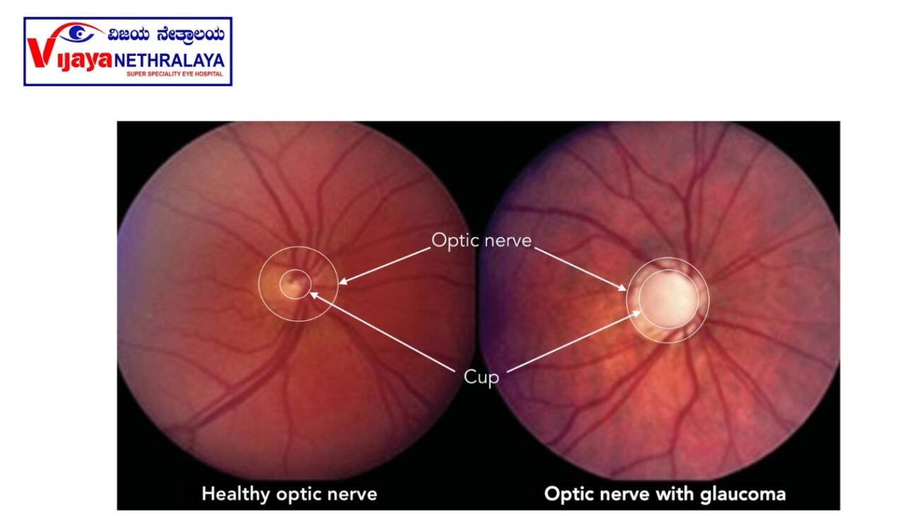 diagnosing  glaucoma