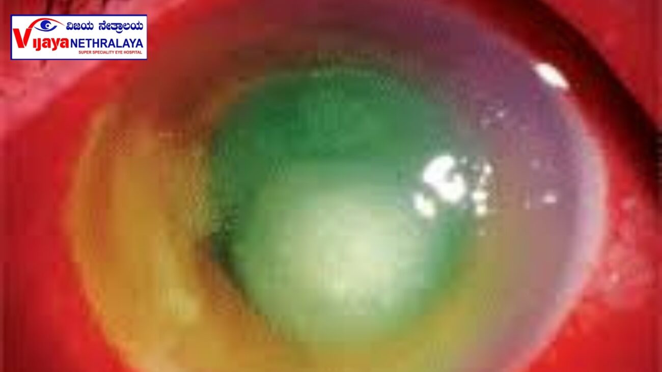 corneal ulcers diagnosis