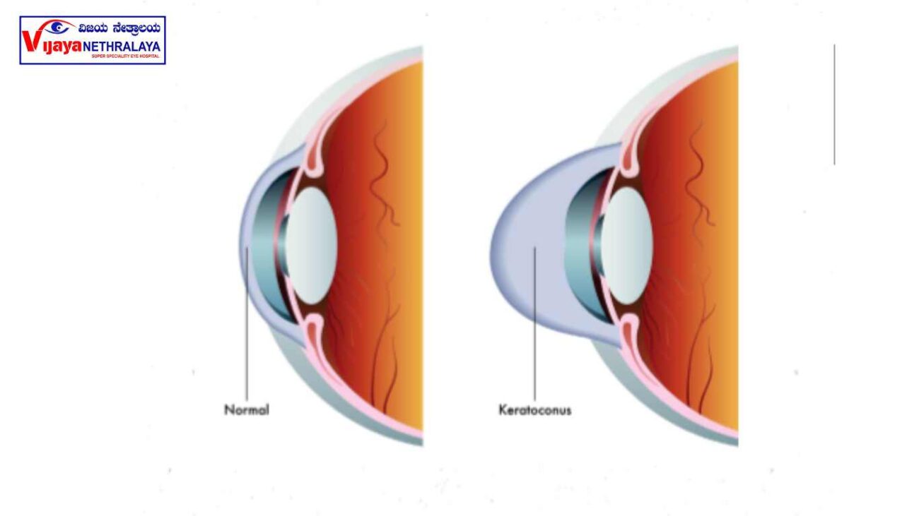 keratoconus eye & cure 