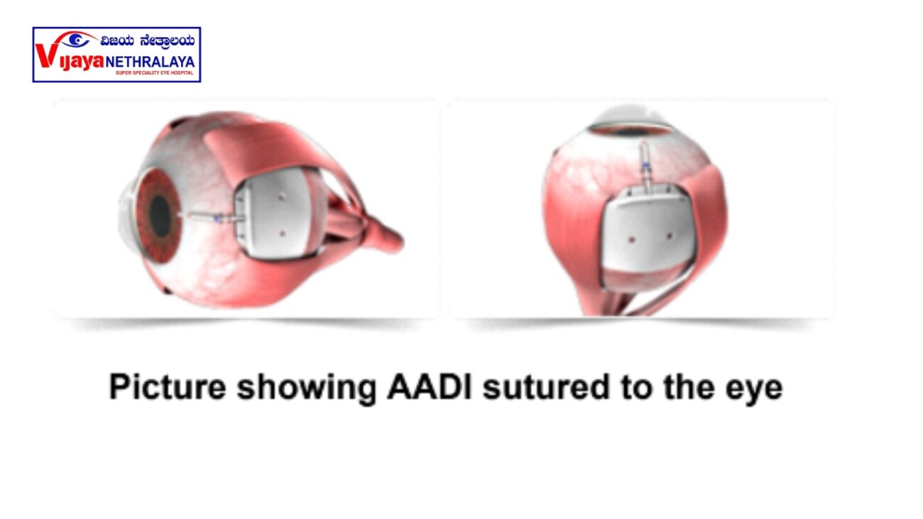 picture showing aadi structured to the eye 