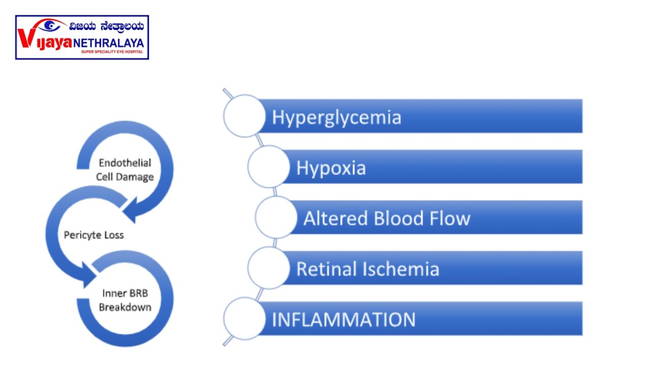 Diabetic Macular Edema