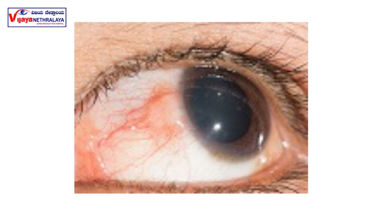 EPISCLERITIS eye