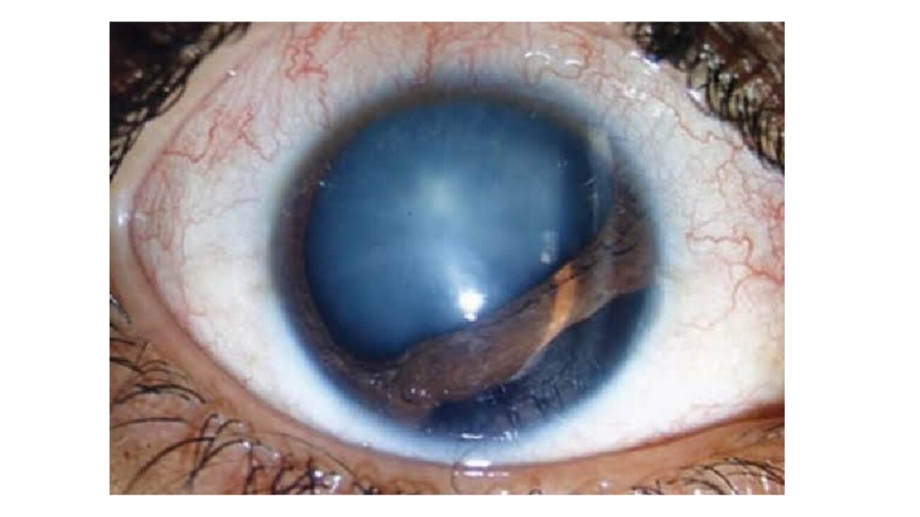 Angle injury eye