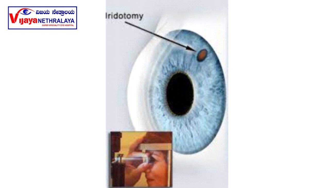 laser iridotomy