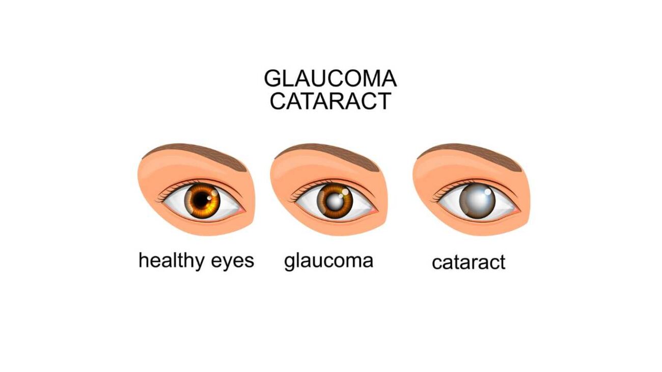 Cataract and Glaucoma Eye