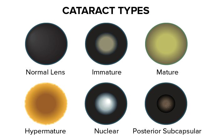 Types of Cataracts/ Motiyabind: