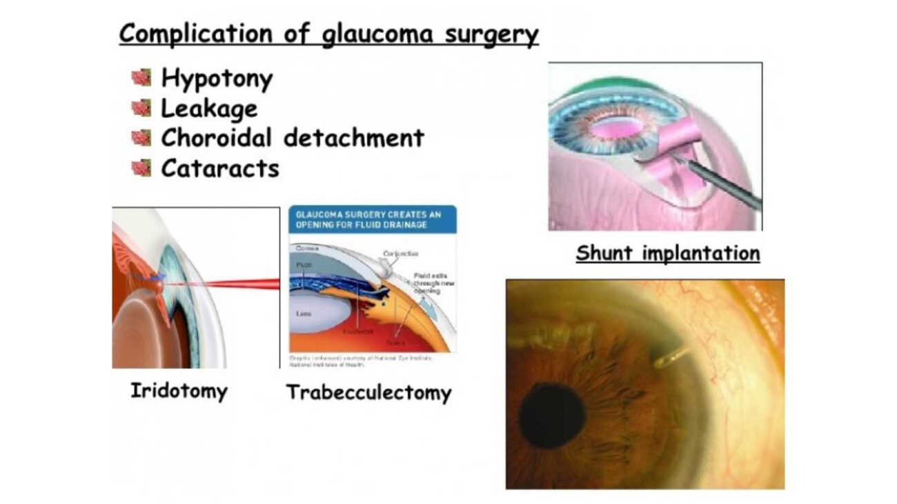 Complications of Glaucoma