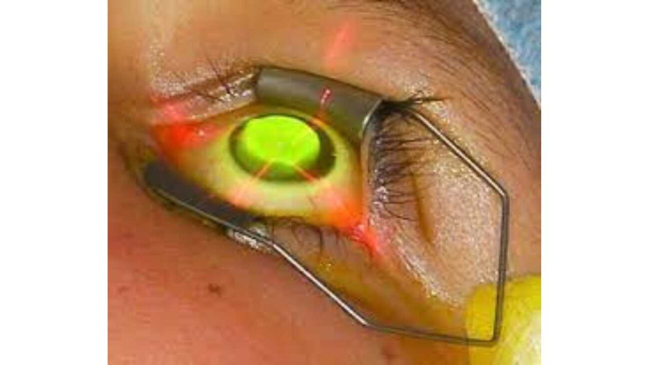 Laser In Eye