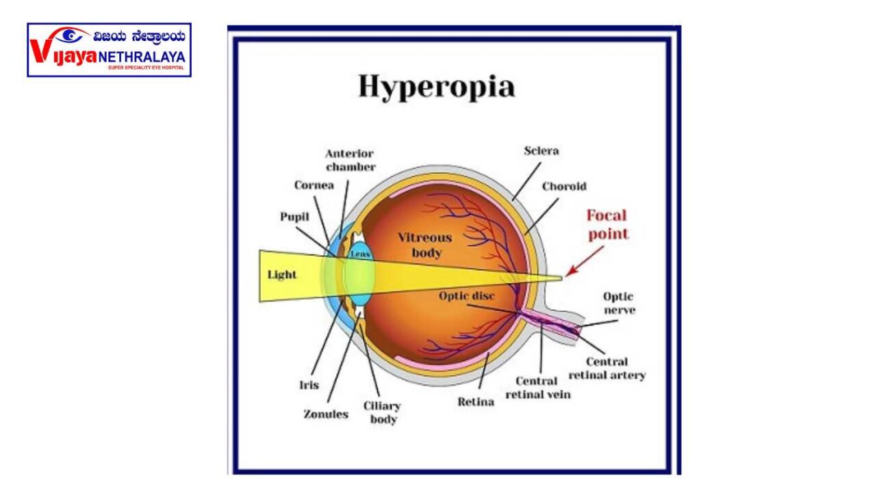 hyperopia