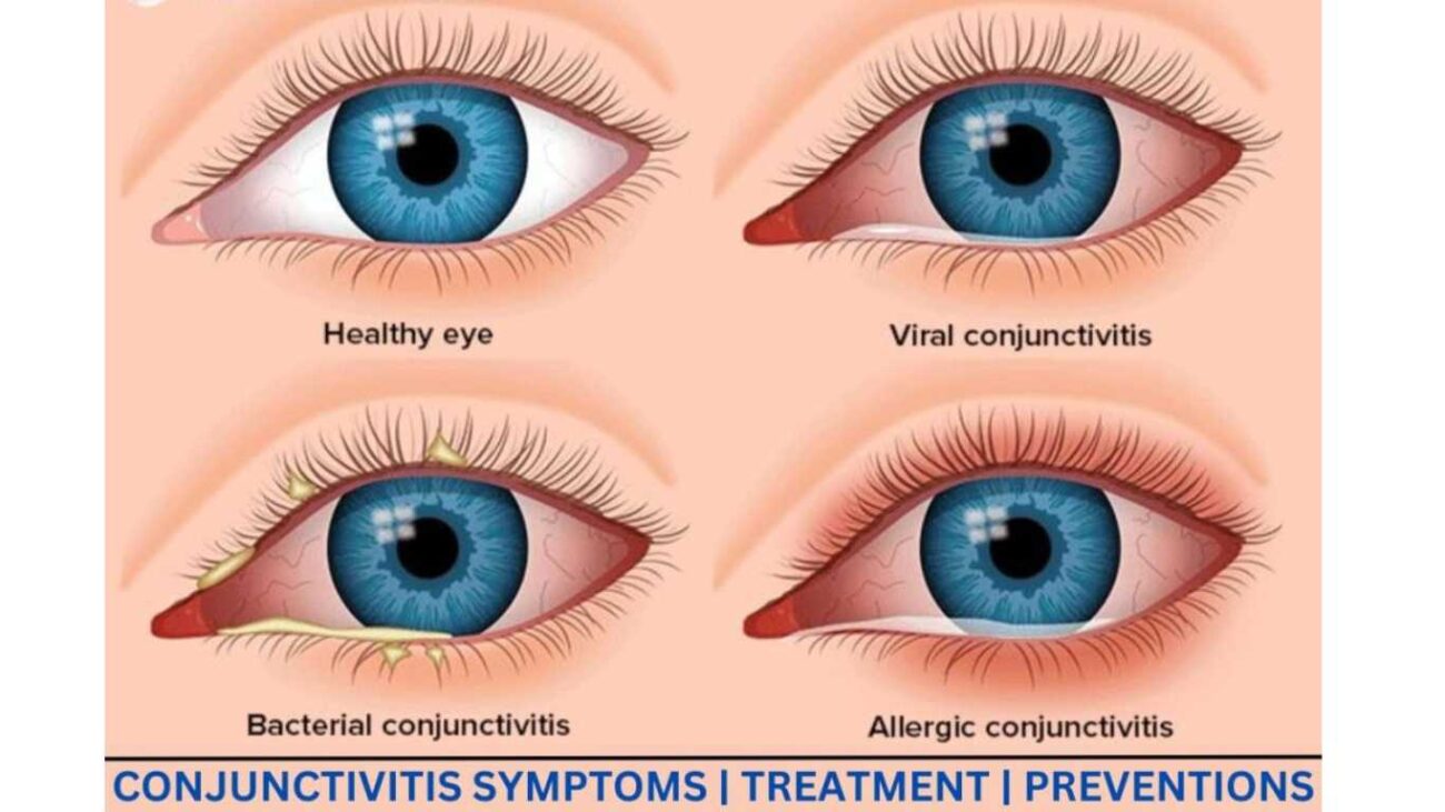 CONJUNCTIVITIS eyes 