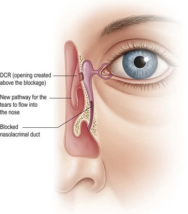 dacryocystorhinostomy