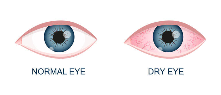 dry eyes in laser eye operation