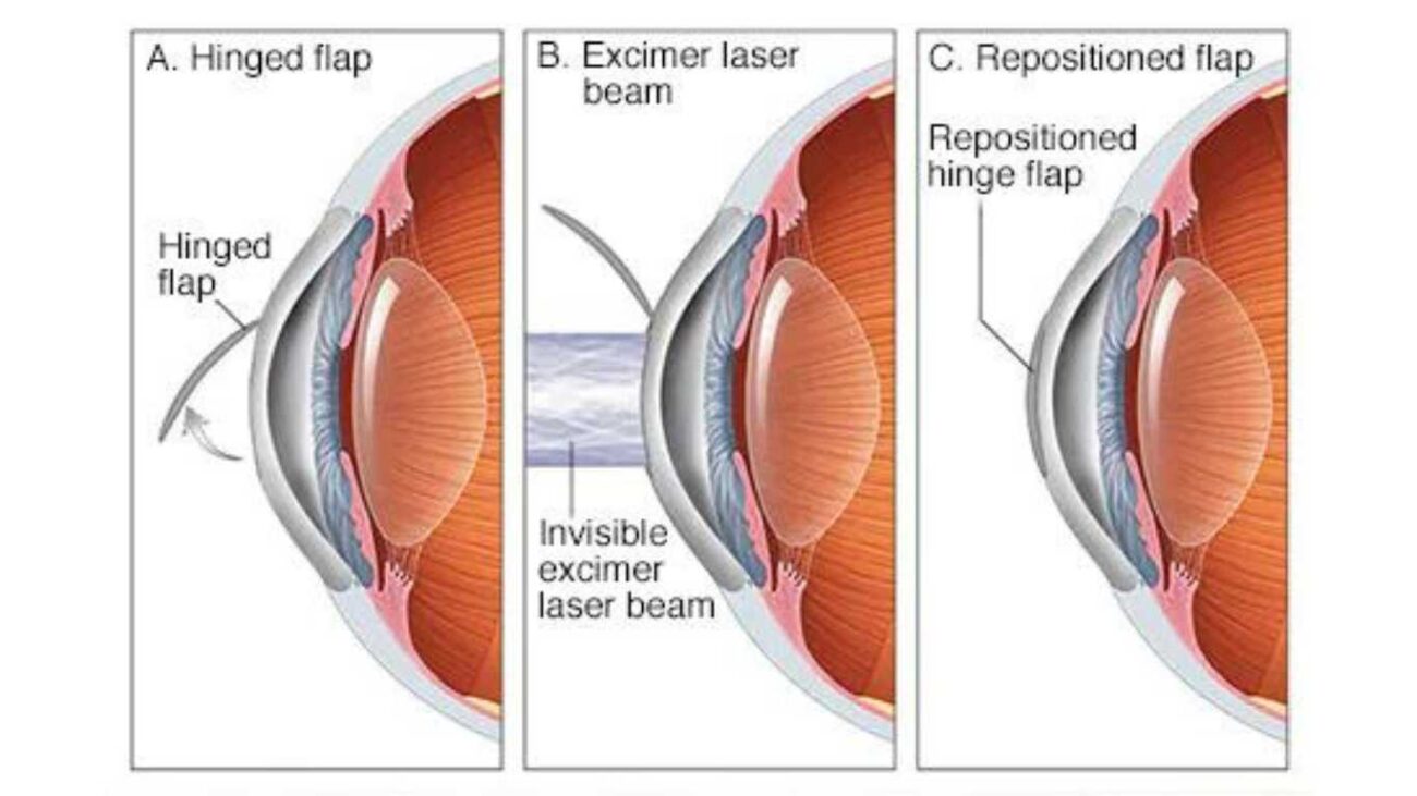 :Lasik /Laser operation for eyes.