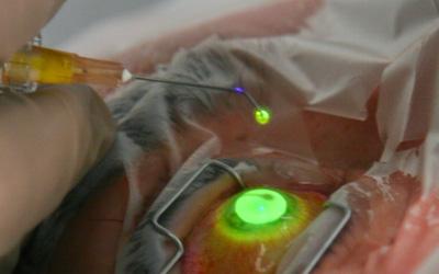 Lasik surgery