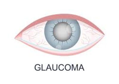 GLAUCOMA