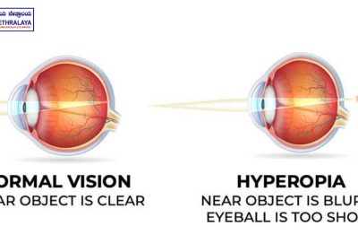 Hyperopia Visual Representation