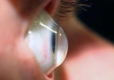 keratoconus eye