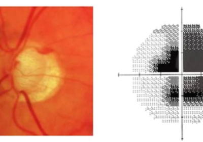 Optic disc cupping with corresponding visual field damage in glaucoma