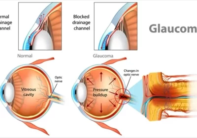 Types of congenital glaucoma